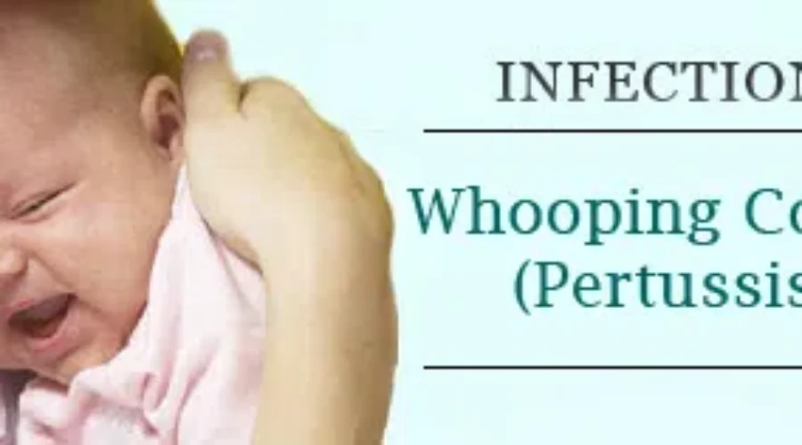 Whooping Cough Outbreak In Southeast NB