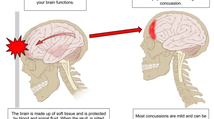 Ken Dryden Says Concussions Are The “Smoking Gun” Of Sports