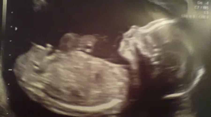 Fetal Alcohol Spectrum Disorder Awareness Campaign Launched