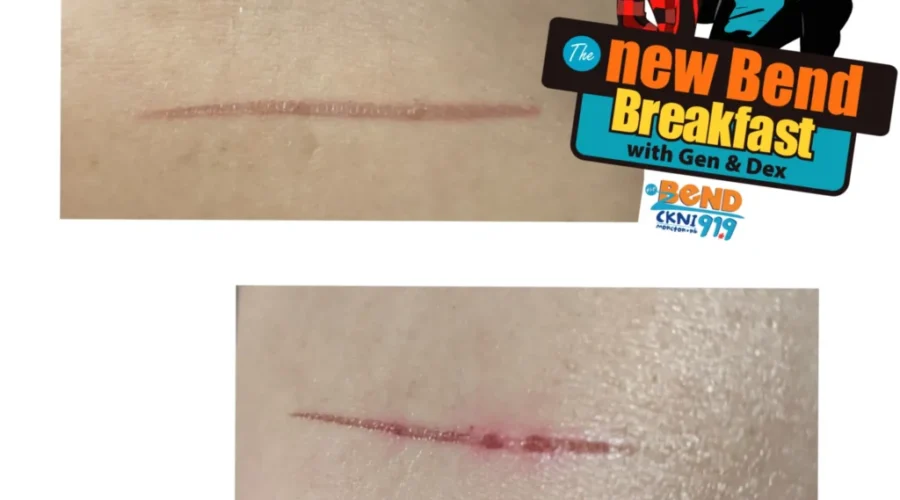 Have you ever accidently burnt yourself? Tell us how