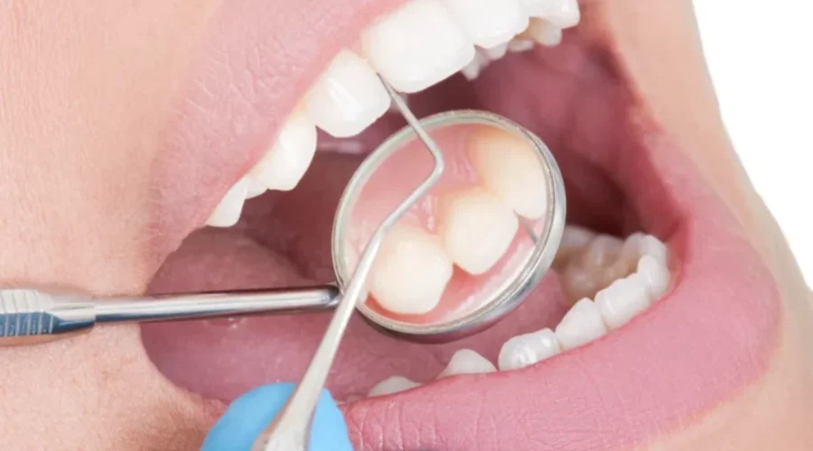 Few N.B. dentists register for new federal dental plan