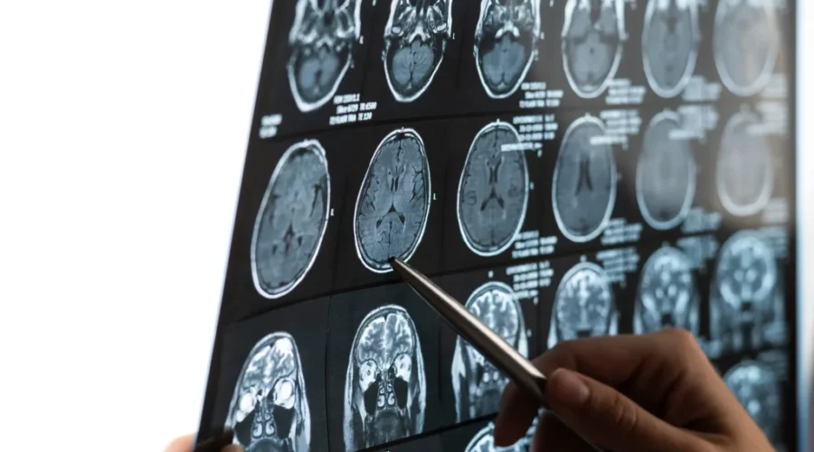 Mystery brain disease: Initial analysis complete, review underway